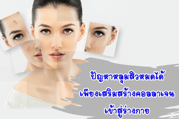 ปัญหาหลุมสิวหมดได้-เพียงเสริมสร้างคอลลาเ ปัญหาหลุมสิวหมดได้-เพียงเสริมสร้างคอลลาเ